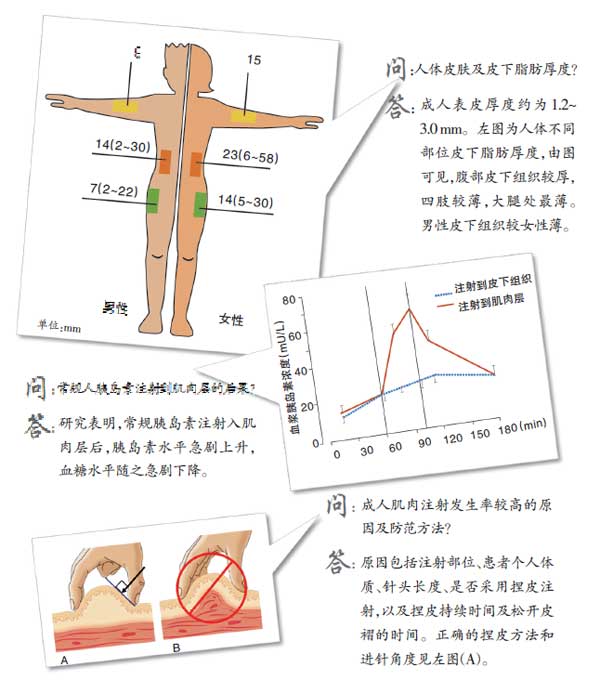 不容忽视的糖尿病药物注射技术